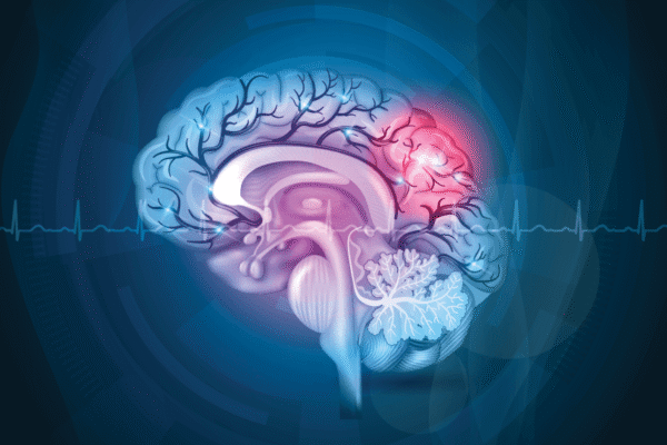 Accidentul vascular cerebral