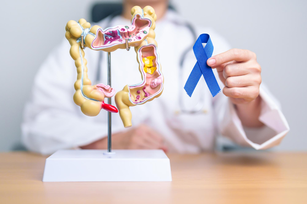 Cancer rectal