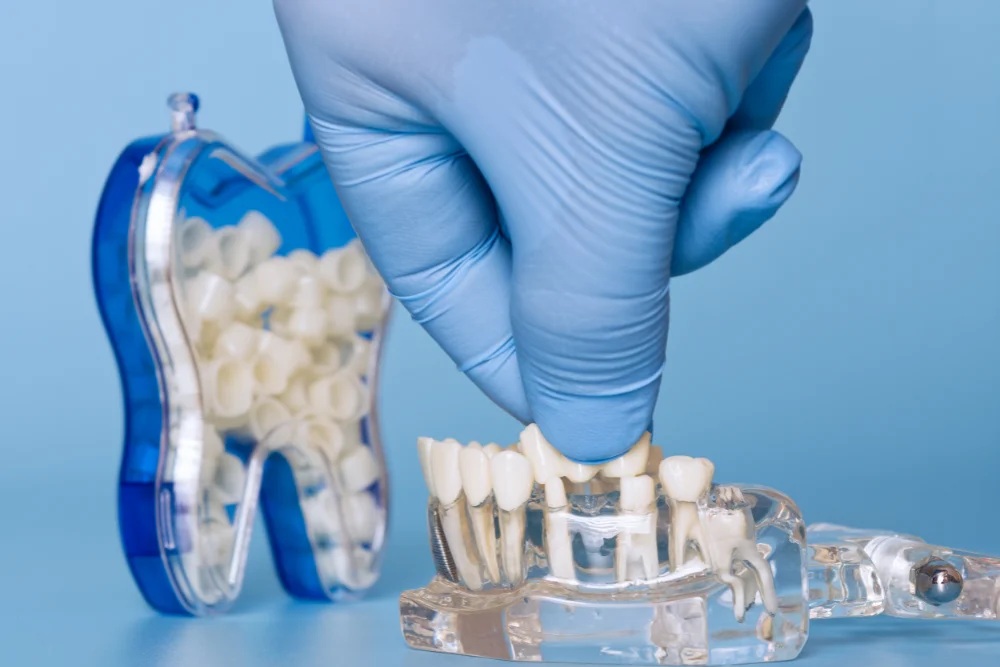 Implantul dentar