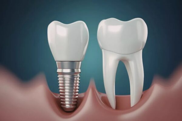 Un implant dentar ieftin este cu adevărat mai ieftin?